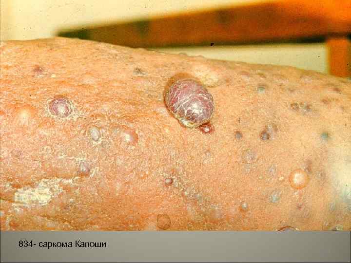 834 - саркома Капоши 10 