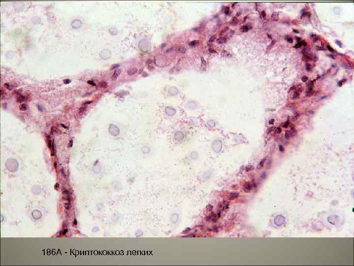 186 А - Криптококкоз легких 11 