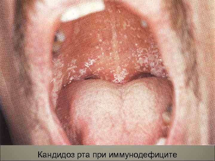 Кандидоз рта при иммунодефиците 13 