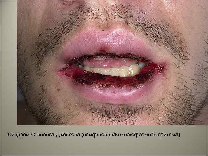 Синдром Стивенса-Джонсона (пемфигоидная многоформная эритема) 