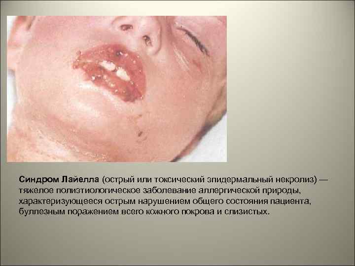 Синдром Лайелла (острый или токсический эпидермальный некролиз) — тяжелое полиэтиологическое заболевание аллергической природы, характеризующееся