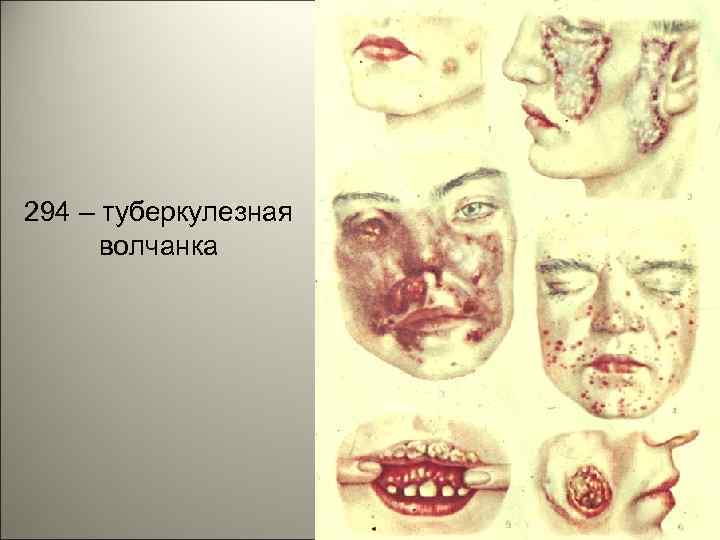 294 – туберкулезная волчанка 31 