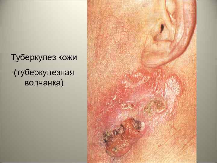 Туберкулез кожи (туберкулезная волчанка) 32 