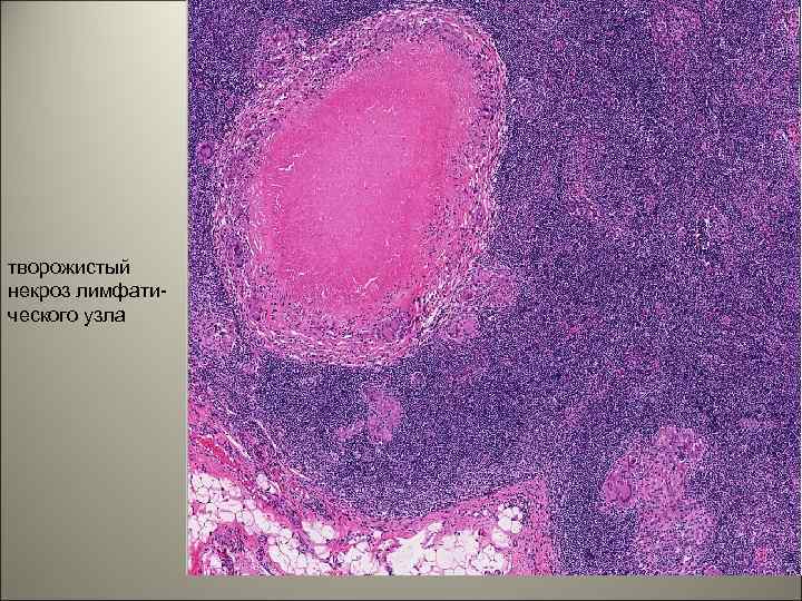 творожистый некроз лимфатического узла 33 