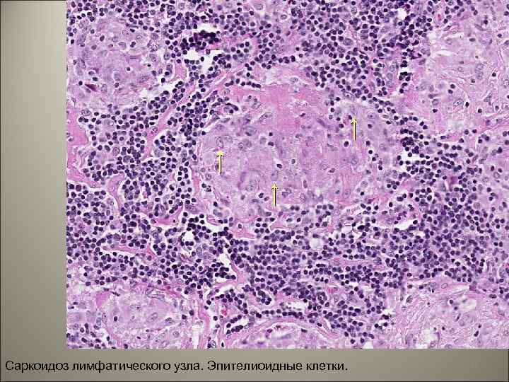 Саркоидоз лимфатического узла. Эпителиоидные клетки. 41 