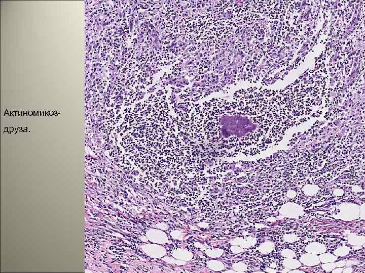 Актиномикоздруза. 49 