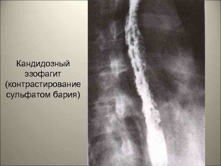 Кандидозный эзофагит (контрастирование сульфатом бария) 57 