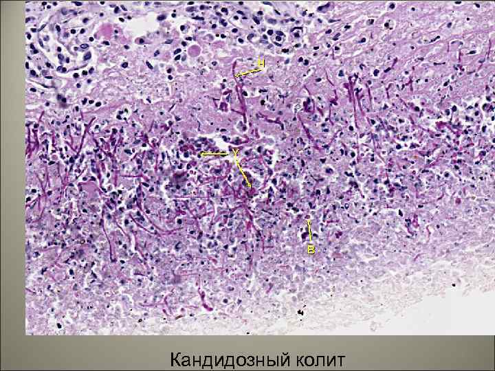 Кандидозный колит 58 