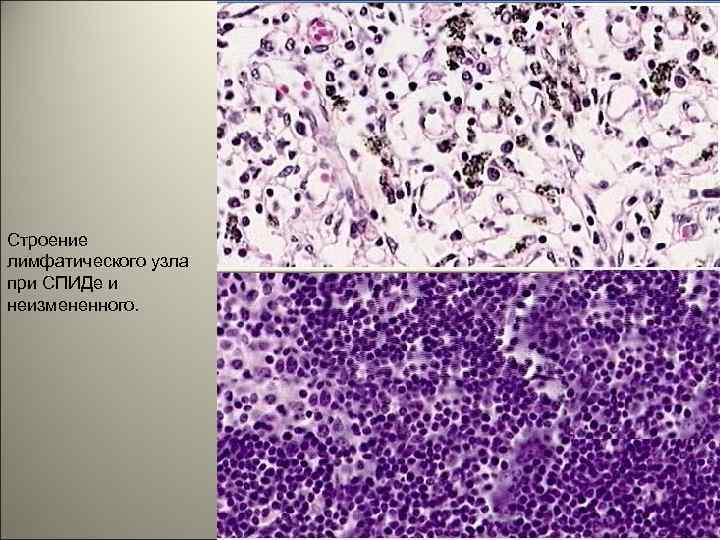 Строение лимфатического узла при СПИДе и неизмененного. 6 