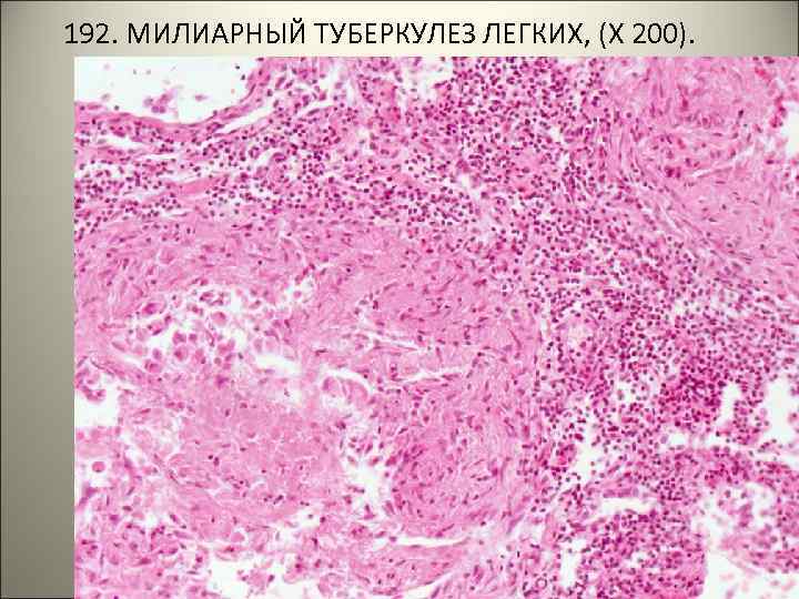  192. МИЛИАРНЫЙ ТУБЕРКУЛЕЗ ЛЕГКИХ, (Х 200). . 