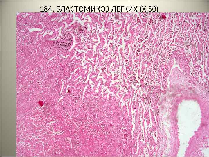 184. БЛАСТОМИКОЗ ЛЕГКИХ (Х 50) 
