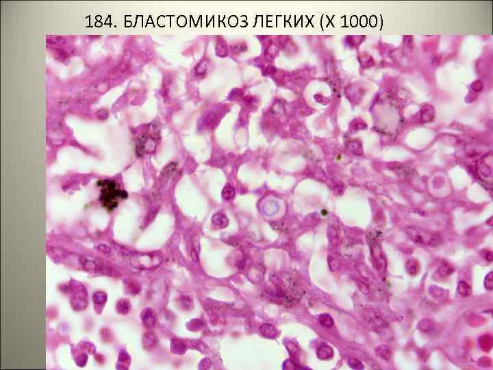 184. БЛАСТОМИКОЗ ЛЕГКИХ (Х 1000) 