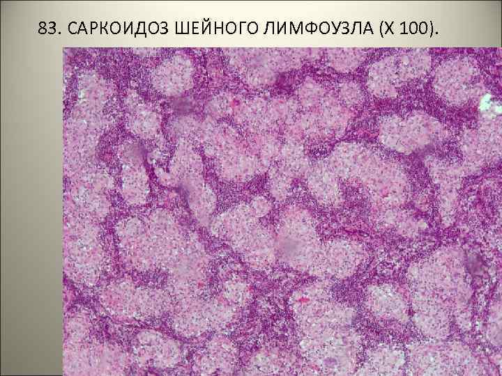 83. САРКОИДОЗ ШЕЙНОГО ЛИМФОУЗЛА (Х 100). 