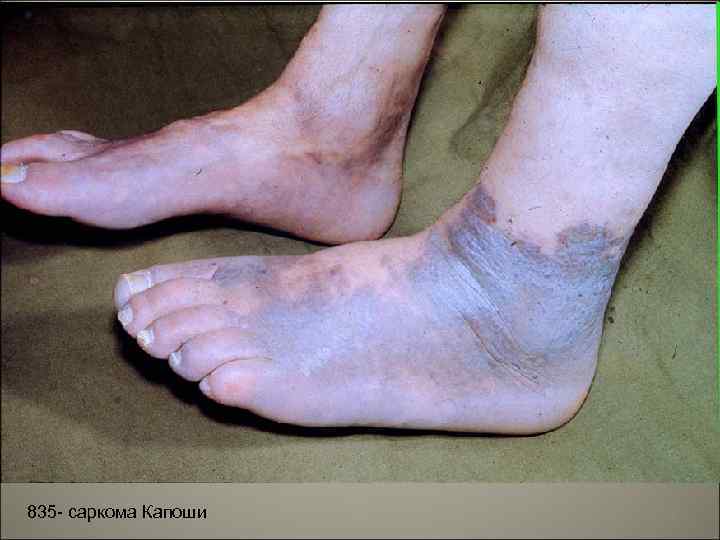 835 - саркома Капоши 9 
