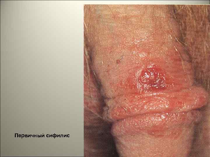 Первичный сифилис 