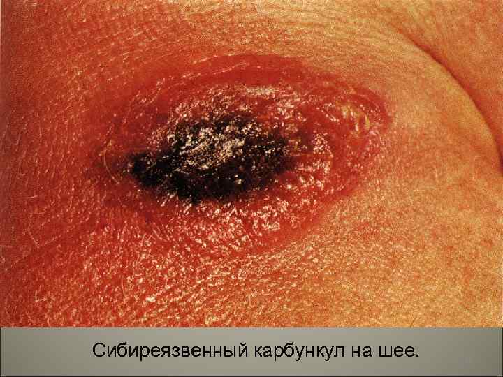 Сибиреязвенный карбункул на шее. 118 