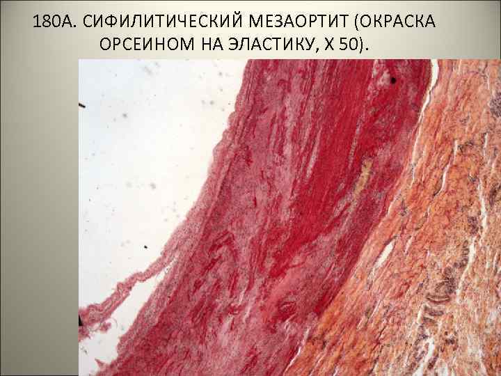 180 А. СИФИЛИТИЧЕСКИЙ МЕЗАОРТИТ (ОКРАСКА ОРСЕИНОМ НА ЭЛАСТИКУ, Х 50). . . 
