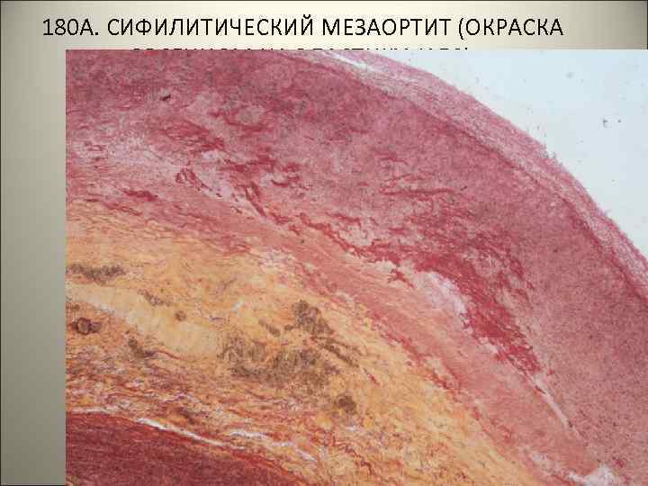  180 А. СИФИЛИТИЧЕСКИЙ МЕЗАОРТИТ (ОКРАСКА ОРСЕИНОМ НА ЭЛАСТИКУ, Х 50). . . 