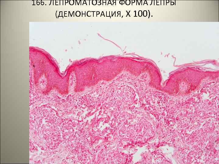 166. ЛЕПРОМАТОЗНАЯ ФОРМА ЛЕПРЫ (ДЕМОНСТРАЦИЯ, Х 100). . 