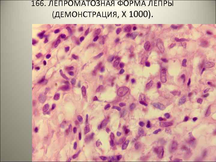 166. ЛЕПРОМАТОЗНАЯ ФОРМА ЛЕПРЫ (ДЕМОНСТРАЦИЯ, Х 1000). . 