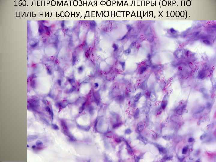 160. ЛЕПРОМАТОЗНАЯ ФОРМА ЛЕПРЫ (ОКР. ПО ЦИЛЬ-НИЛЬСОНУ, ДЕМОНСТРАЦИЯ, Х 1000). . 