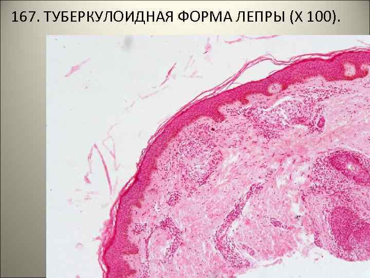 167. ТУБЕРКУЛОИДНАЯ ФОРМА ЛЕПРЫ (Х 100). . 