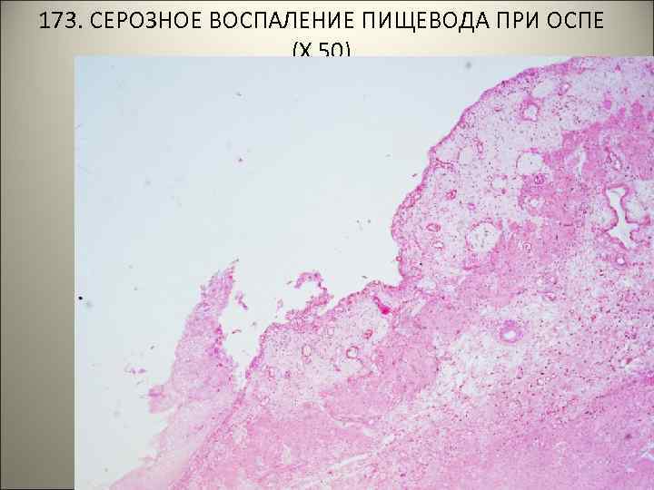 173. СЕРОЗНОЕ ВОСПАЛЕНИЕ ПИЩЕВОДА ПРИ ОСПЕ (Х 50). . . 