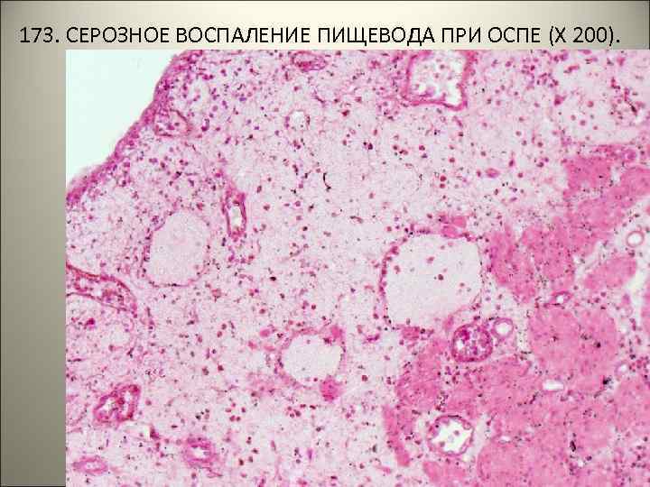  173. СЕРОЗНОЕ ВОСПАЛЕНИЕ ПИЩЕВОДА ПРИ ОСПЕ (Х 200). . . 
