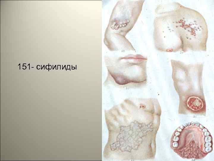151 - сифилиды 20 