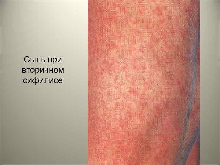 Сыпь при вторичном сифилисе 21 