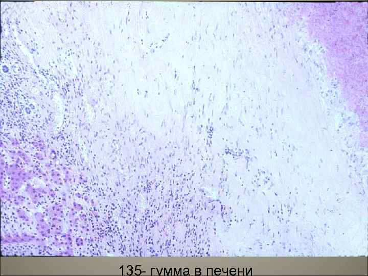 135 - гумма в печени 27 