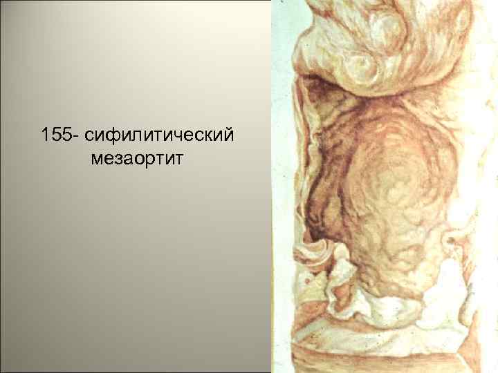 155 - сифилитический мезаортит 30 