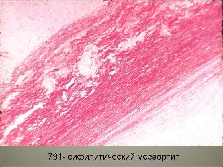 791 - сифилитический мезаортит 34 