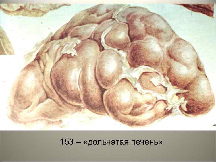 153 – «дольчатая печень» 37 