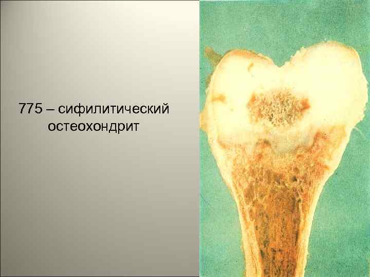 775 – сифилитический остеохондрит 39 