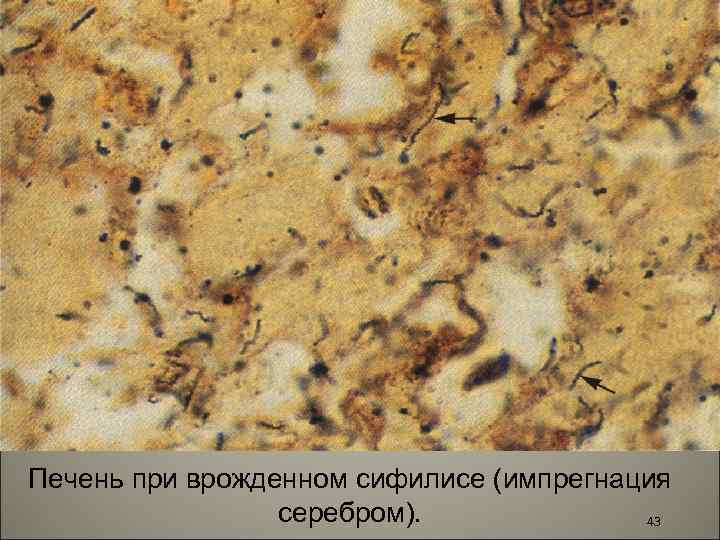 Печень при врожденном сифилисе (импрегнация серебром). 43 