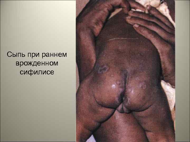 Сыпь при раннем врожденном сифилисе 46 