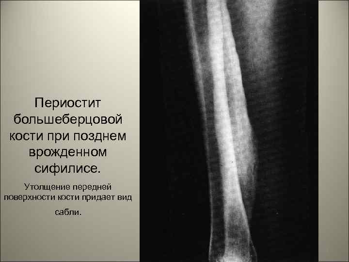 Периостит большеберцовой кости при позднем врожденном сифилисе. Утолщение передней поверхности кости придает вид сабли.