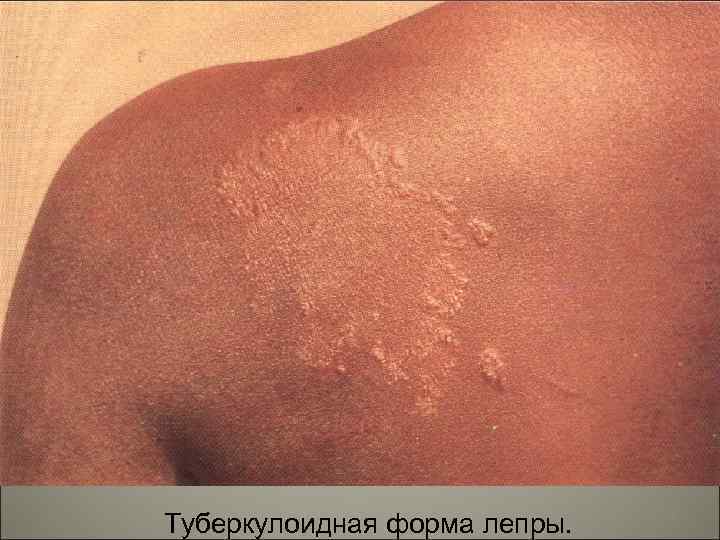 Туберкулоидная форма лепры. 58 