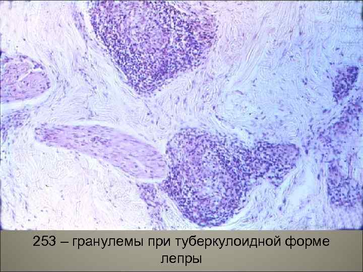 253 – гранулемы при туберкулоидной форме лепры 59 