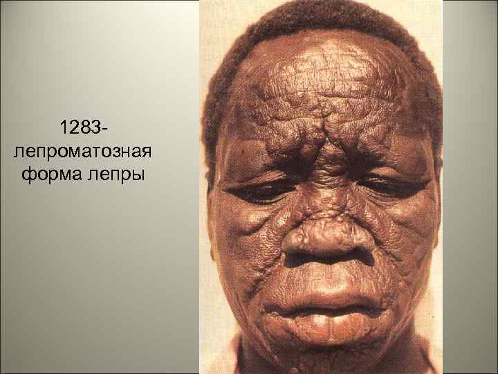 1283 лепроматозная форма лепры 61 