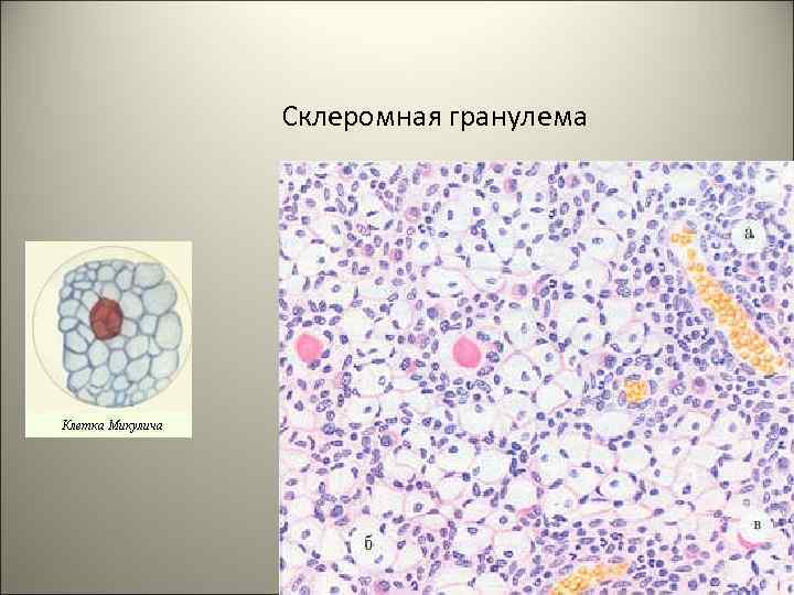 Склеромная гранулема 72 