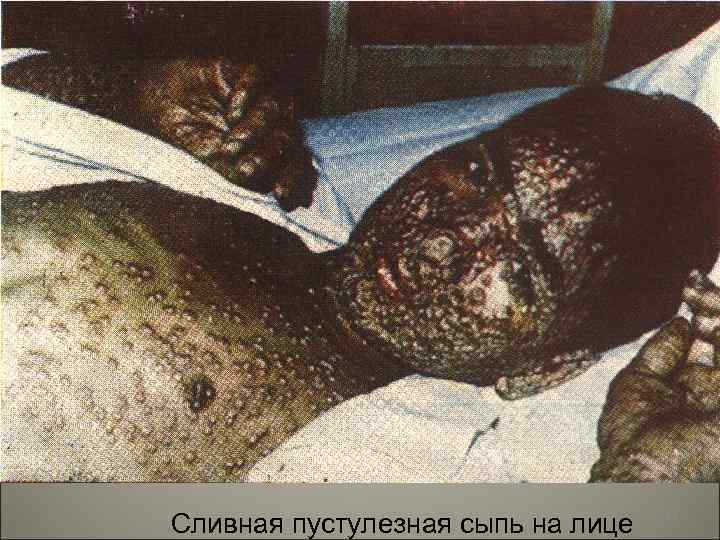 Сливная пустулезная сыпь на лице 94 