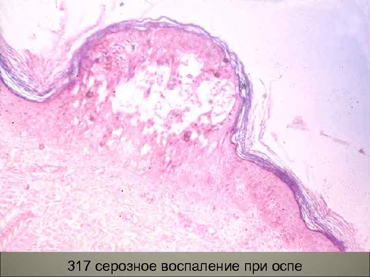 317 серозное воспаление при оспе 95 