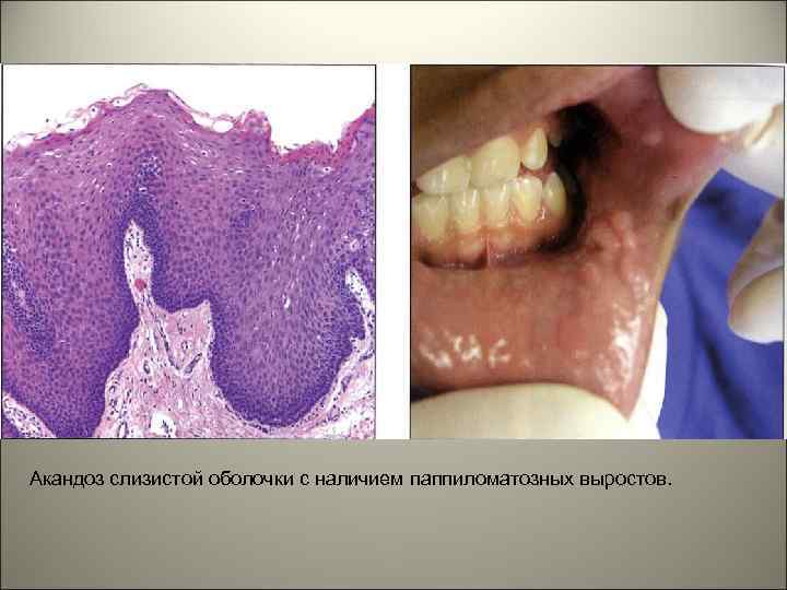 Акандоз слизистой оболочки с наличием паппиломатозных выростов. 