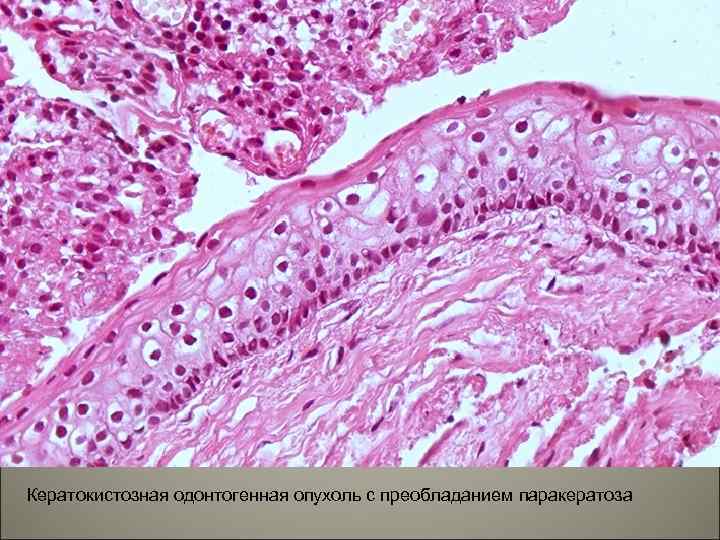 Кератокистозная одонтогенная опухоль с преобладанием паракератоза 