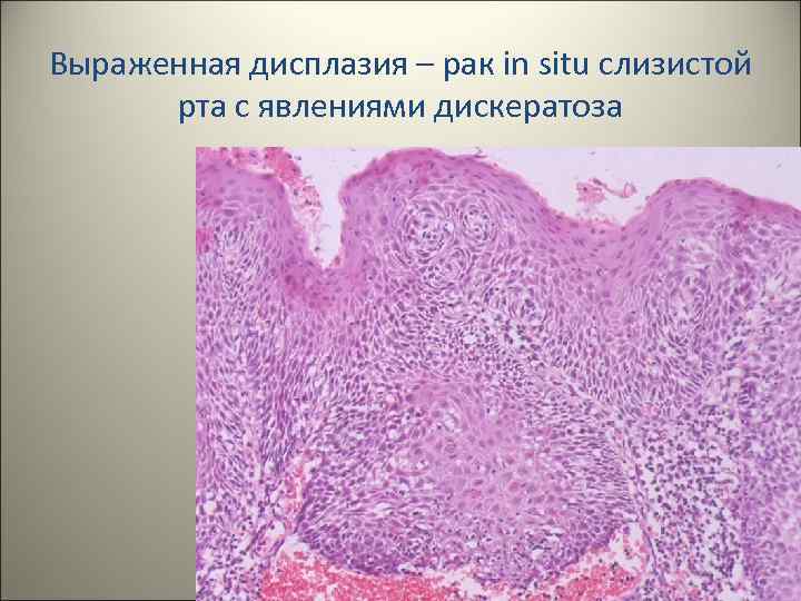 Выраженная дисплазия – рак in situ слизистой рта с явлениями дискератоза 16 