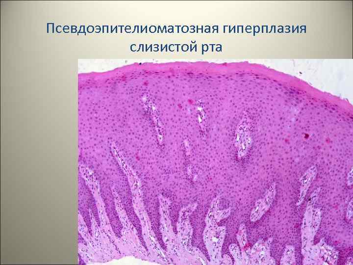 Псевдоэпителиоматозная гиперплазия слизистой рта 18 