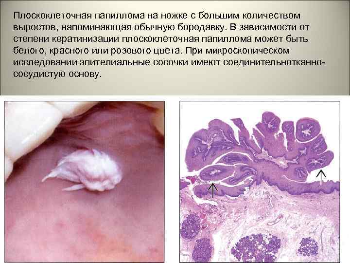 Плоскоклеточная папиллома на ножке с большим количеством выростов, напоминающая обычную бородавку. В зависимости от
