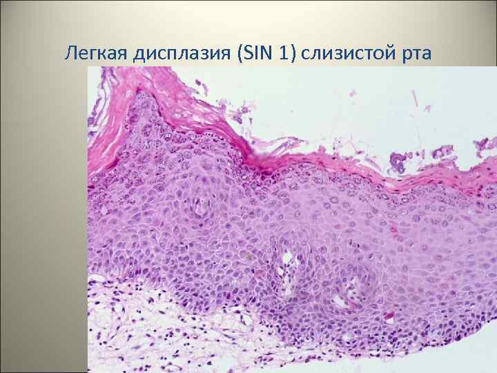 Легкая дисплазия (SIN 1) слизистой рта 28 